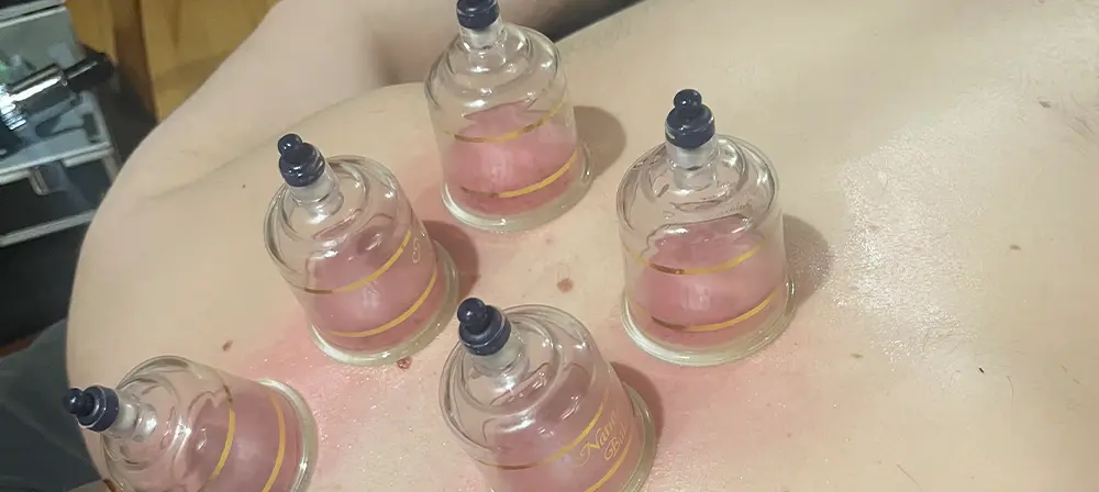 Cupping therapy
